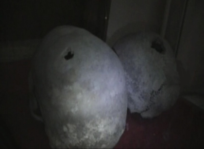 TREPANACION CRANEANA 05